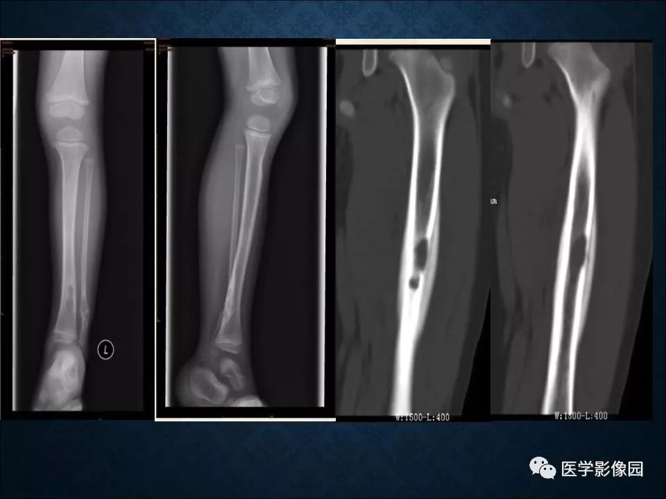【PPT】长骨嗜酸性肉芽肿影像诊断与鉴别诊断