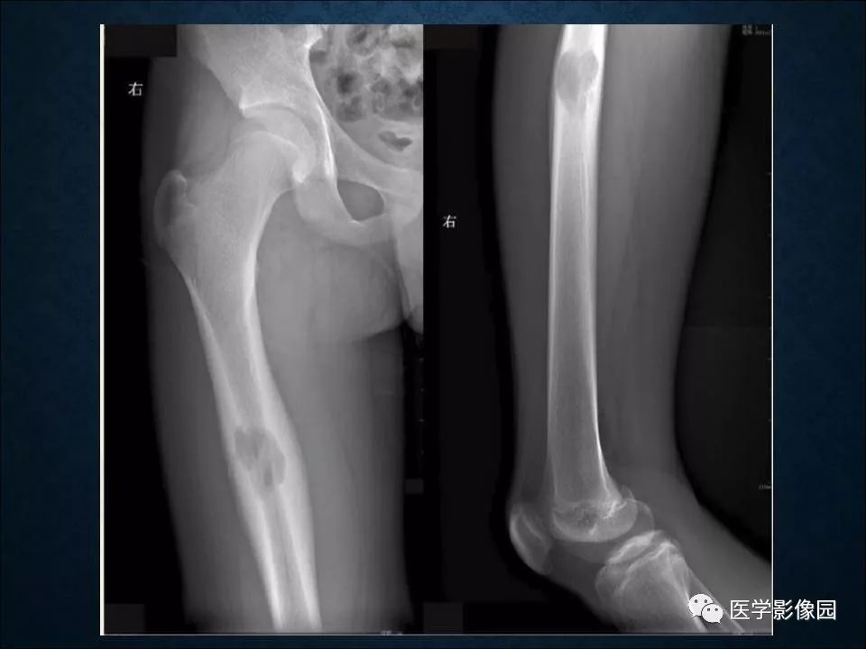 【PPT】长骨嗜酸性肉芽肿影像诊断与鉴别诊断