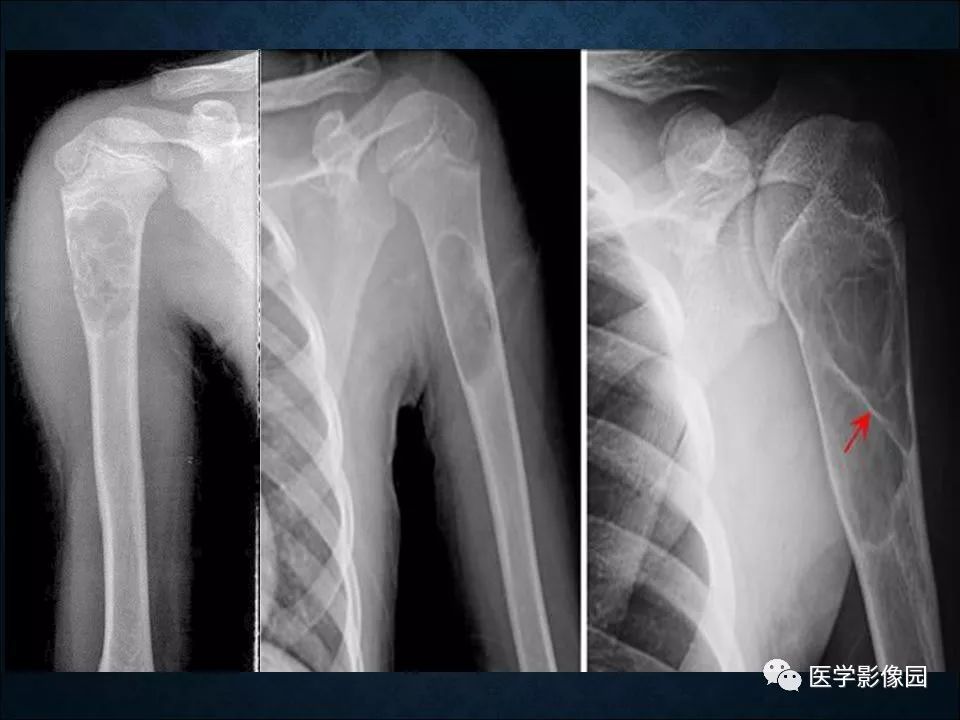 【PPT】长骨嗜酸性肉芽肿影像诊断与鉴别诊断