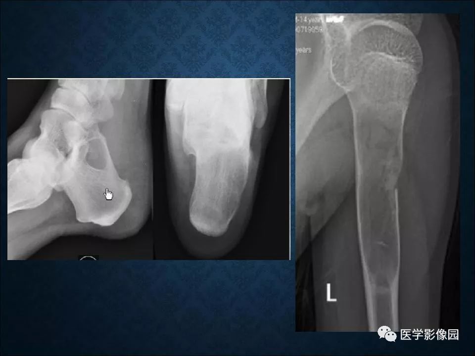 【PPT】长骨嗜酸性肉芽肿影像诊断与鉴别诊断