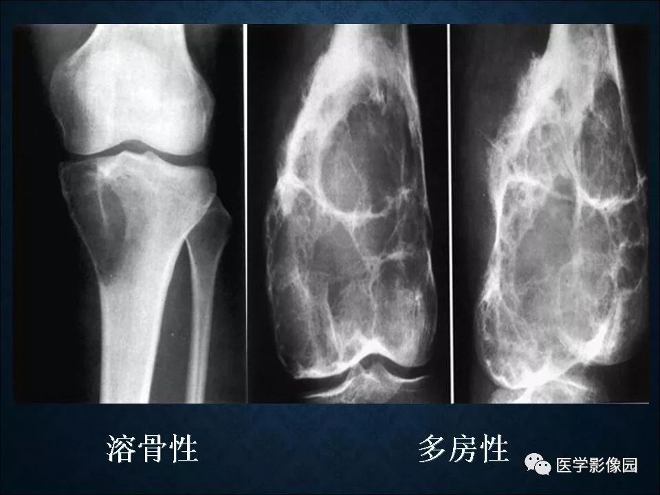 【PPT】长骨嗜酸性肉芽肿影像诊断与鉴别诊断