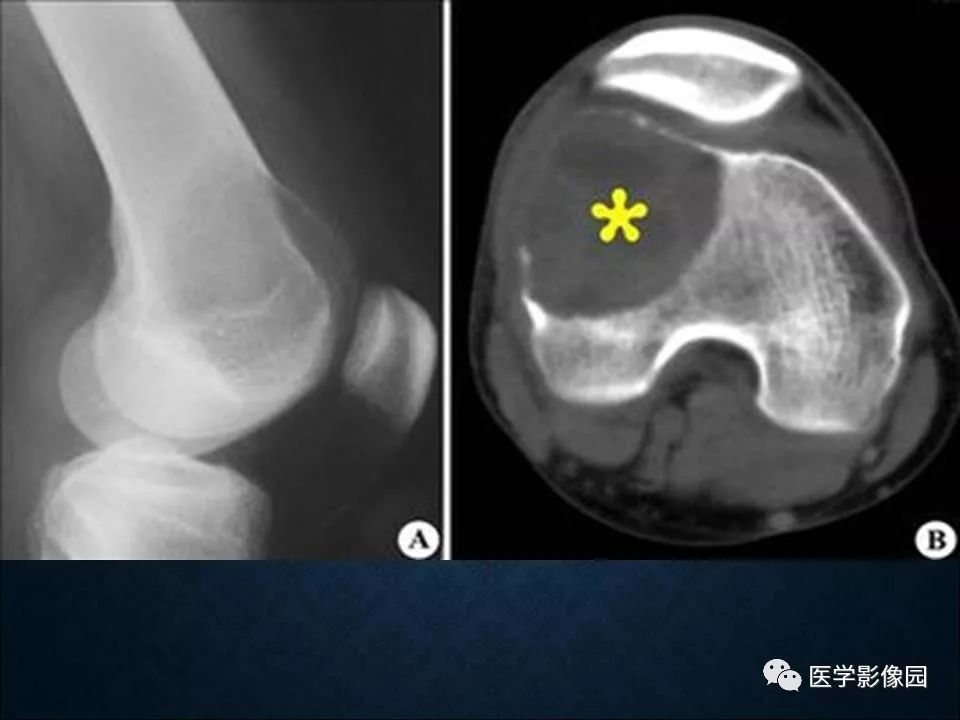 【PPT】长骨嗜酸性肉芽肿影像诊断与鉴别诊断