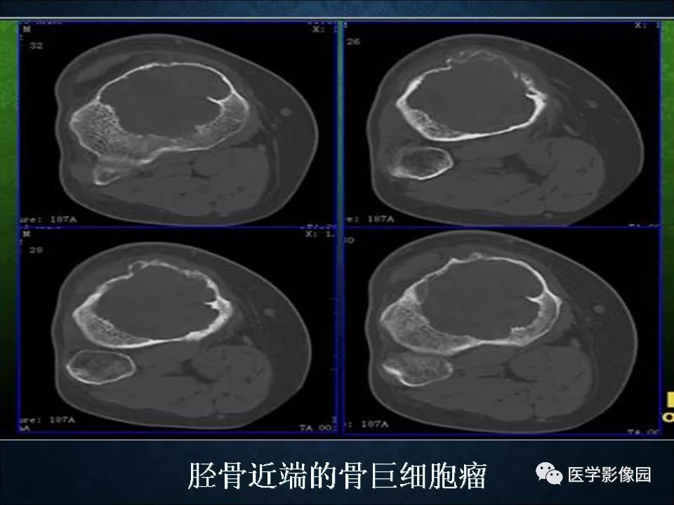 【PPT】长骨嗜酸性肉芽肿影像诊断与鉴别诊断