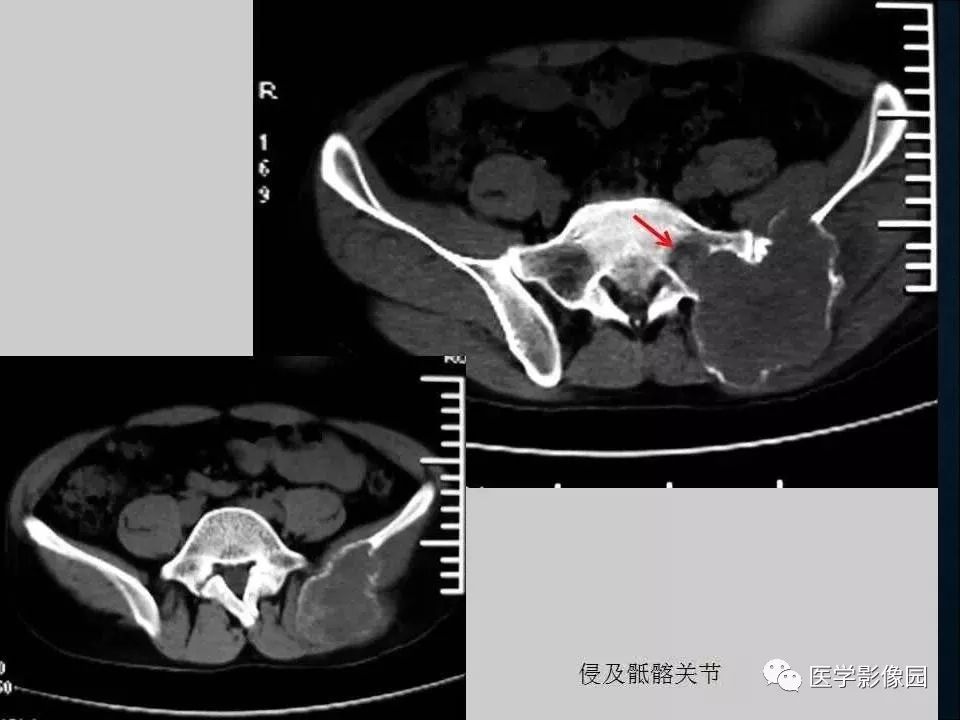 【PPT】长骨嗜酸性肉芽肿影像诊断与鉴别诊断
