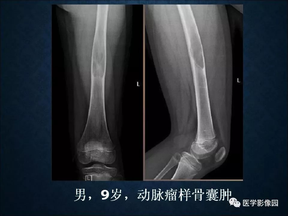 【PPT】长骨嗜酸性肉芽肿影像诊断与鉴别诊断