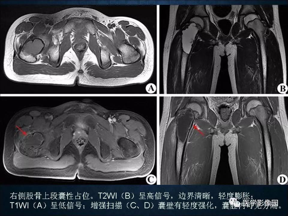 【PPT】长骨嗜酸性肉芽肿影像诊断与鉴别诊断
