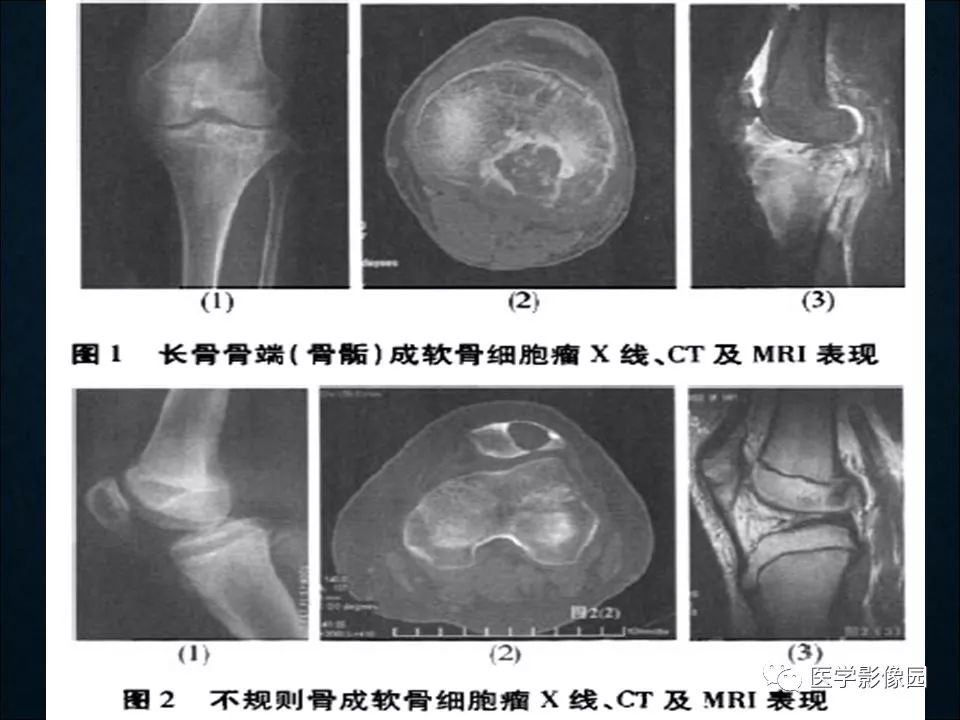 【PPT】长骨嗜酸性肉芽肿影像诊断与鉴别诊断