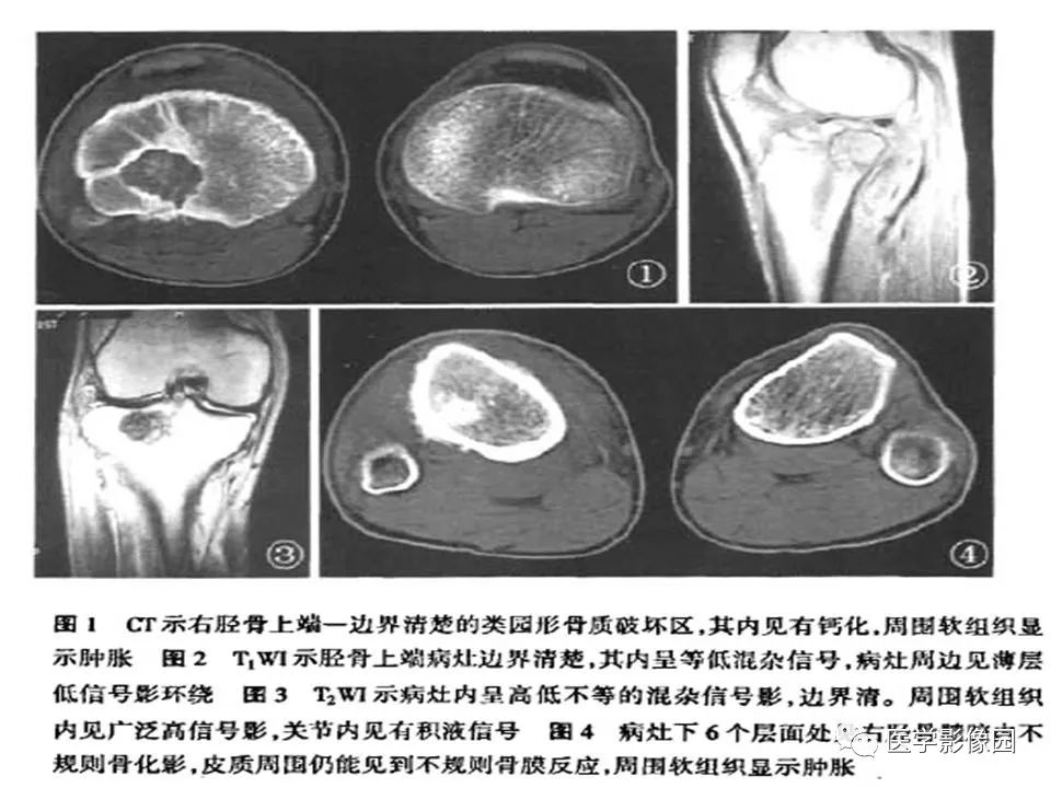 【PPT】长骨嗜酸性肉芽肿影像诊断与鉴别诊断
