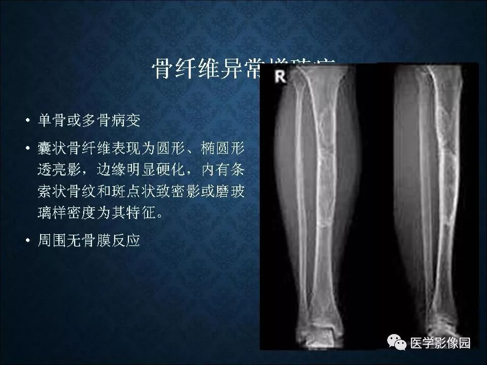 【PPT】长骨嗜酸性肉芽肿影像诊断与鉴别诊断
