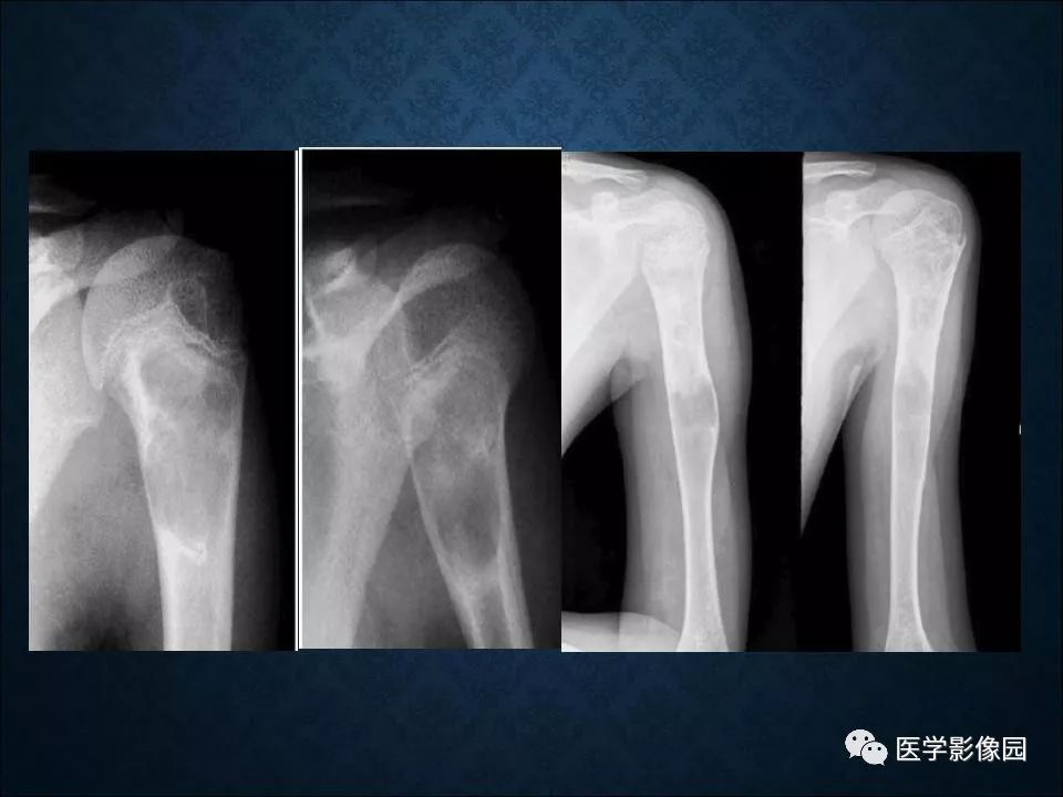 【PPT】长骨嗜酸性肉芽肿影像诊断与鉴别诊断