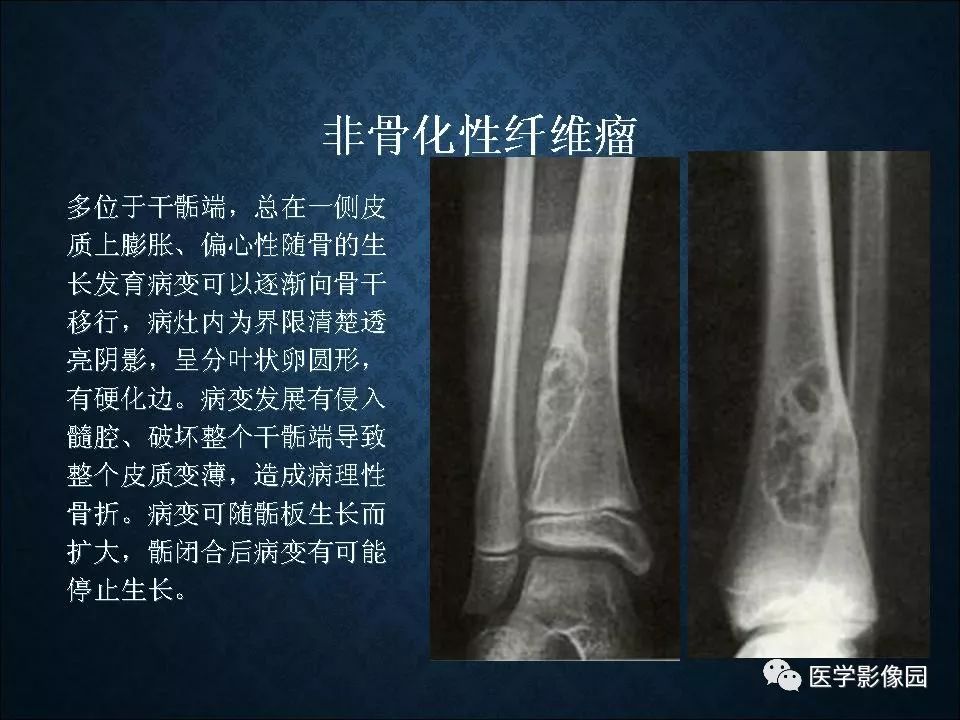 【PPT】长骨嗜酸性肉芽肿影像诊断与鉴别诊断