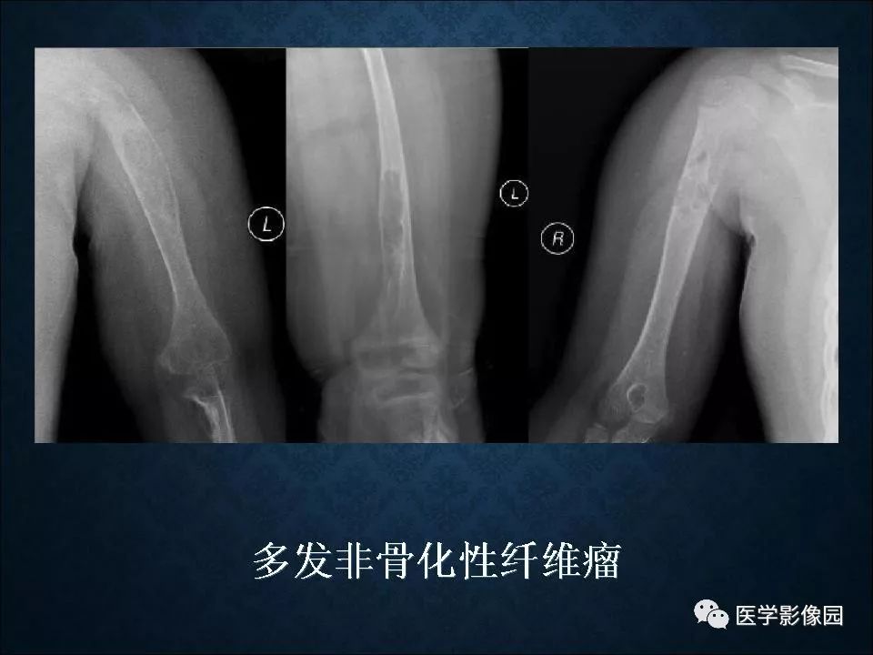 【PPT】长骨嗜酸性肉芽肿影像诊断与鉴别诊断