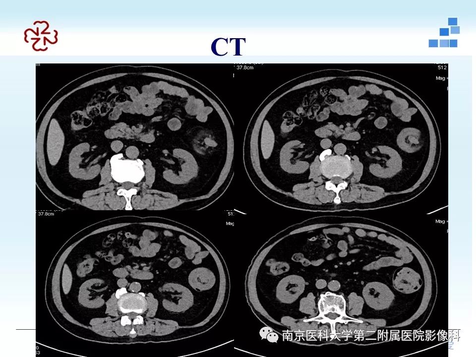 【PPT】专题读片—成人肠套叠