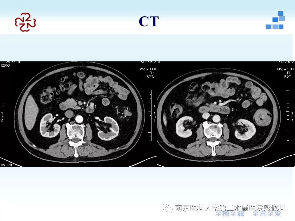 【PPT】专题读片—成人肠套叠