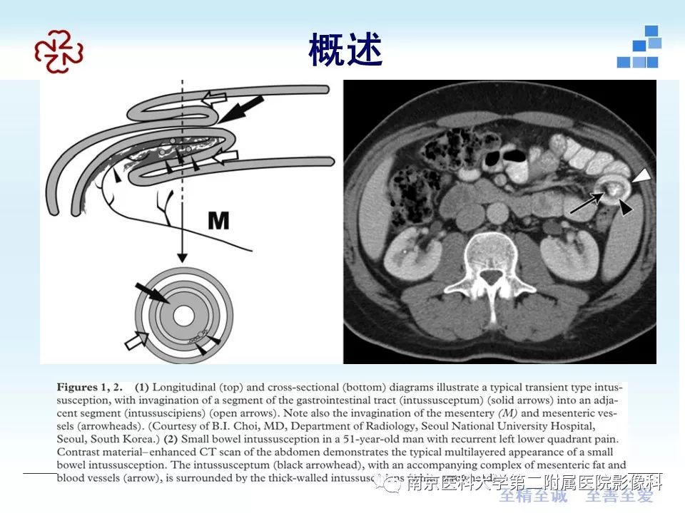 【PPT】专题读片—成人肠套叠