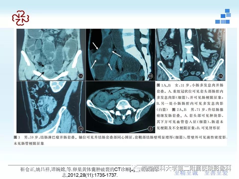【PPT】专题读片—成人肠套叠