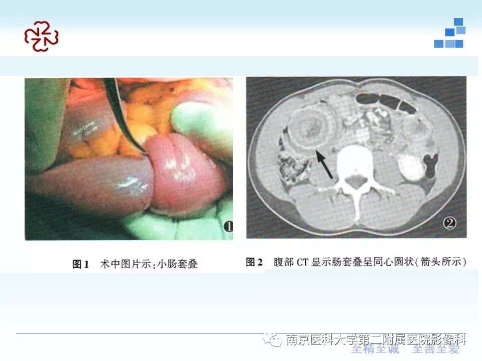 【PPT】专题读片—成人肠套叠