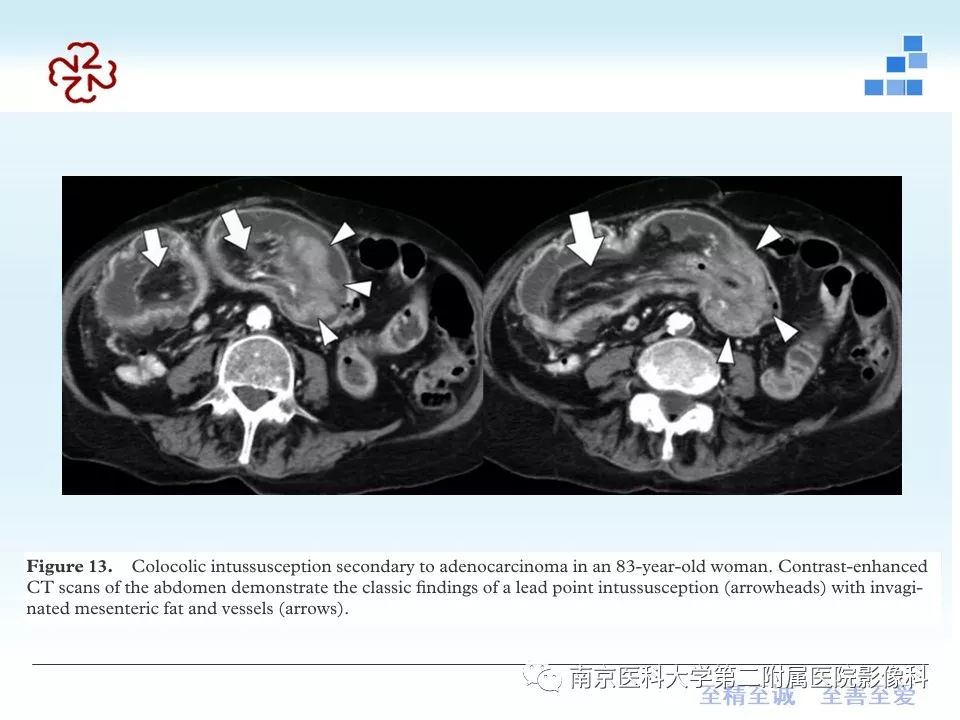 【PPT】专题读片—成人肠套叠