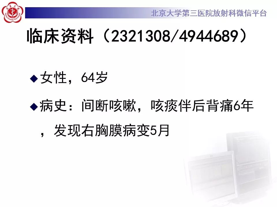 【病例】胸膜孤立性纤维瘤1例CT影像诊断