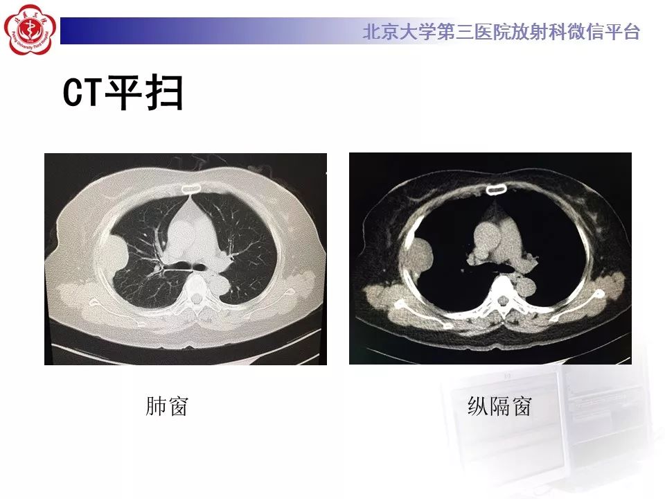 【病例】胸膜孤立性纤维瘤1例CT影像诊断