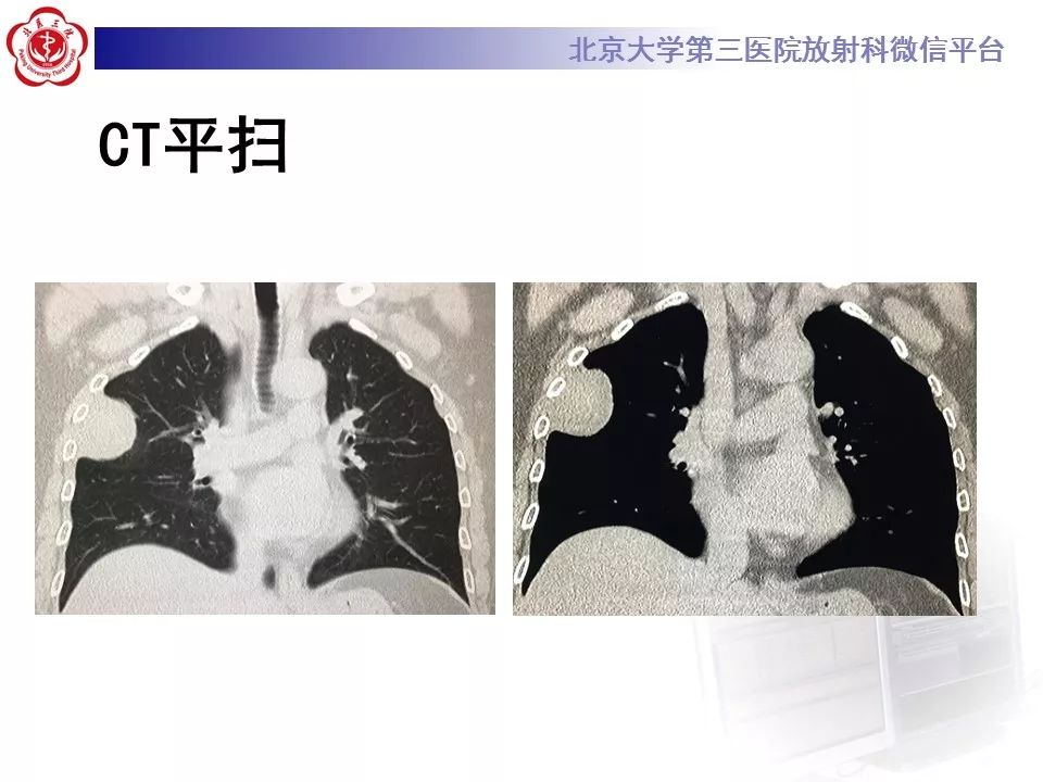 【病例】胸膜孤立性纤维瘤1例CT影像诊断