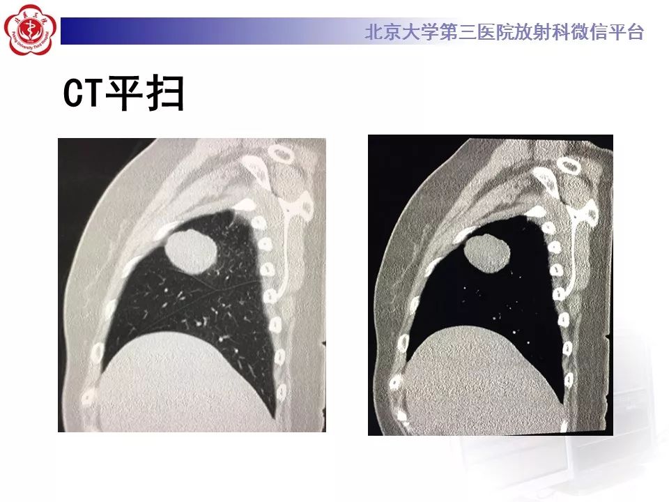 【病例】胸膜孤立性纤维瘤1例CT影像诊断