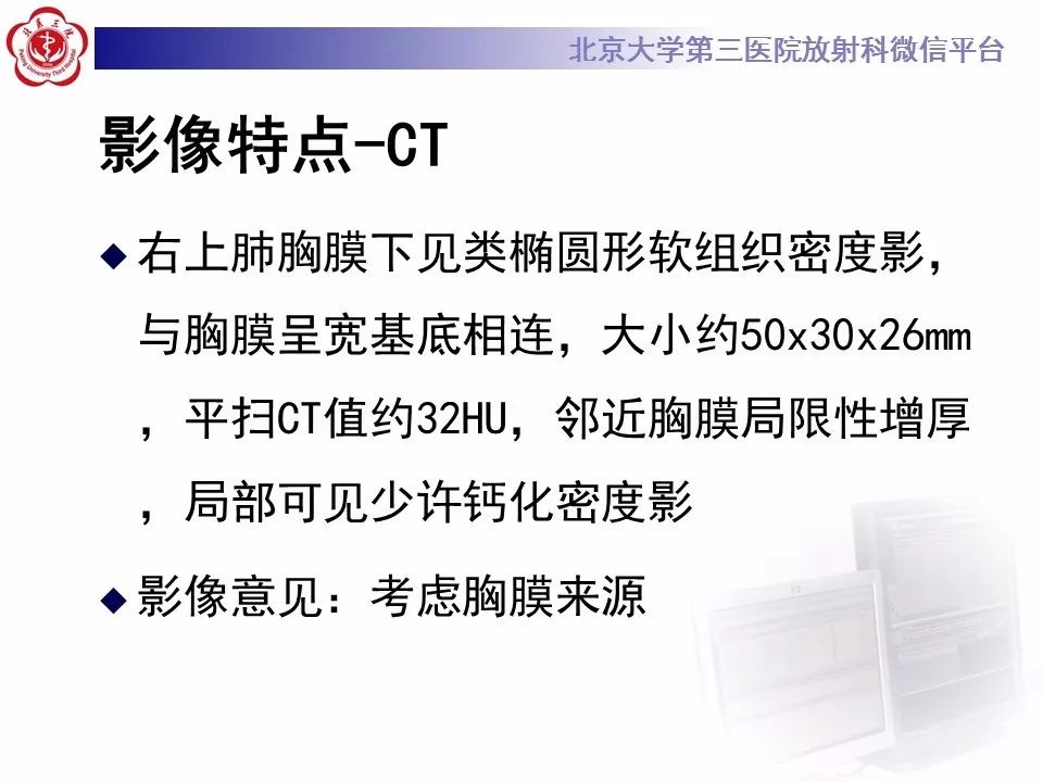 【病例】胸膜孤立性纤维瘤1例CT影像诊断