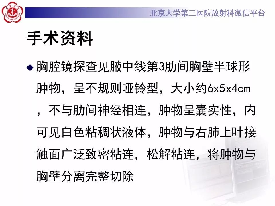 【病例】胸膜孤立性纤维瘤1例CT影像诊断