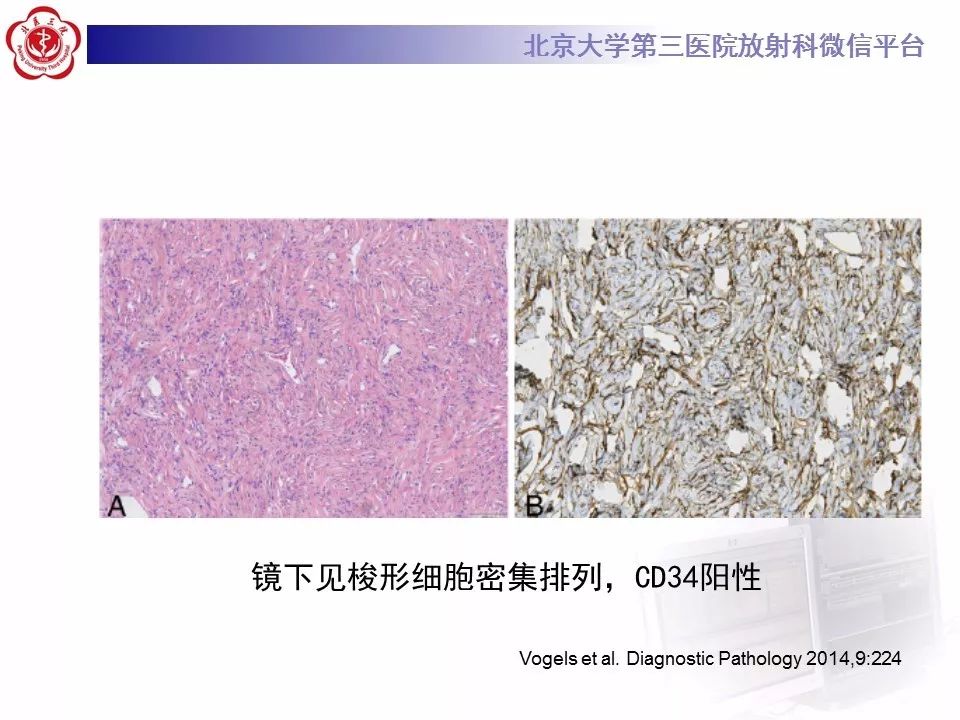 【病例】胸膜孤立性纤维瘤1例CT影像诊断