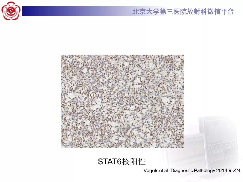 【病例】胸膜孤立性纤维瘤1例CT影像诊断