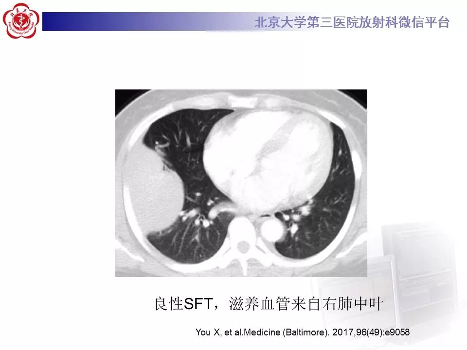 【病例】胸膜孤立性纤维瘤1例CT影像诊断