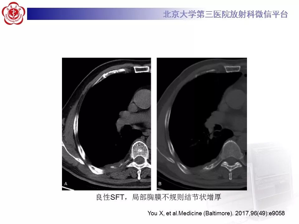 【病例】胸膜孤立性纤维瘤1例CT影像诊断