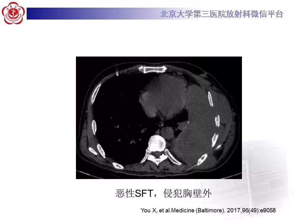 【病例】胸膜孤立性纤维瘤1例CT影像诊断