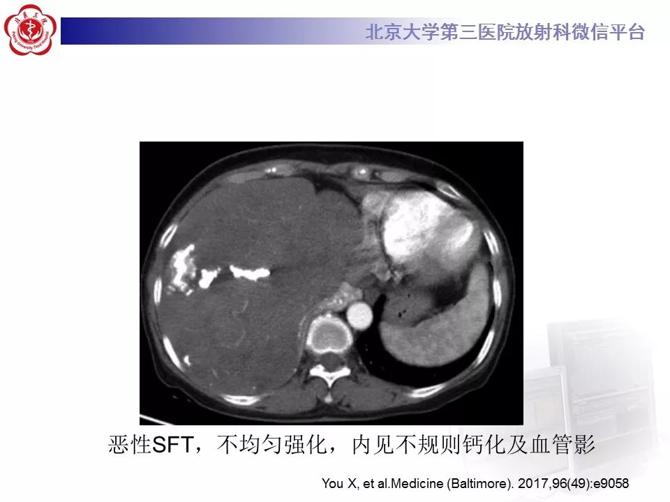 【病例】胸膜孤立性纤维瘤1例CT影像诊断
