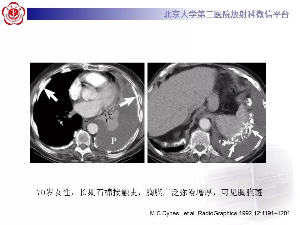 【病例】胸膜孤立性纤维瘤1例CT影像诊断