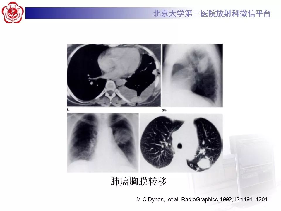 【病例】胸膜孤立性纤维瘤1例CT影像诊断