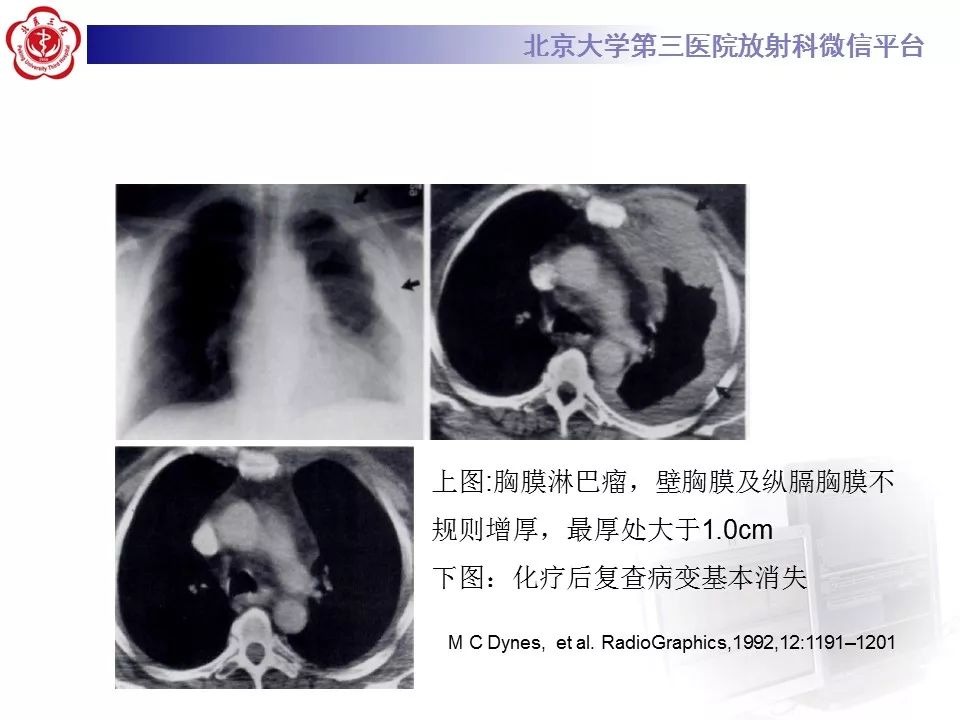 【病例】胸膜孤立性纤维瘤1例CT影像诊断