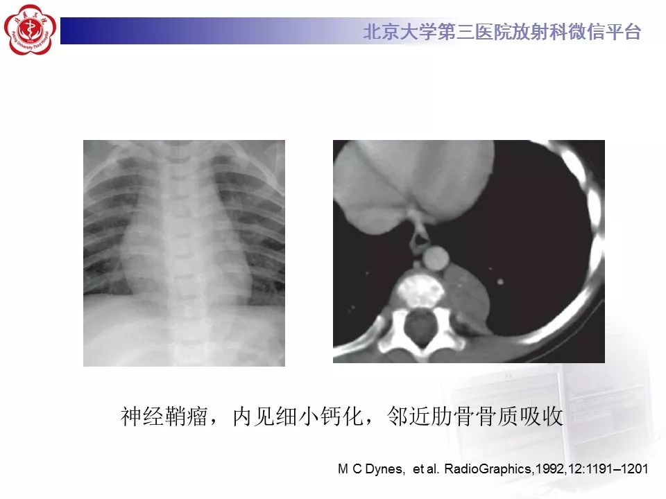 【病例】胸膜孤立性纤维瘤1例CT影像诊断