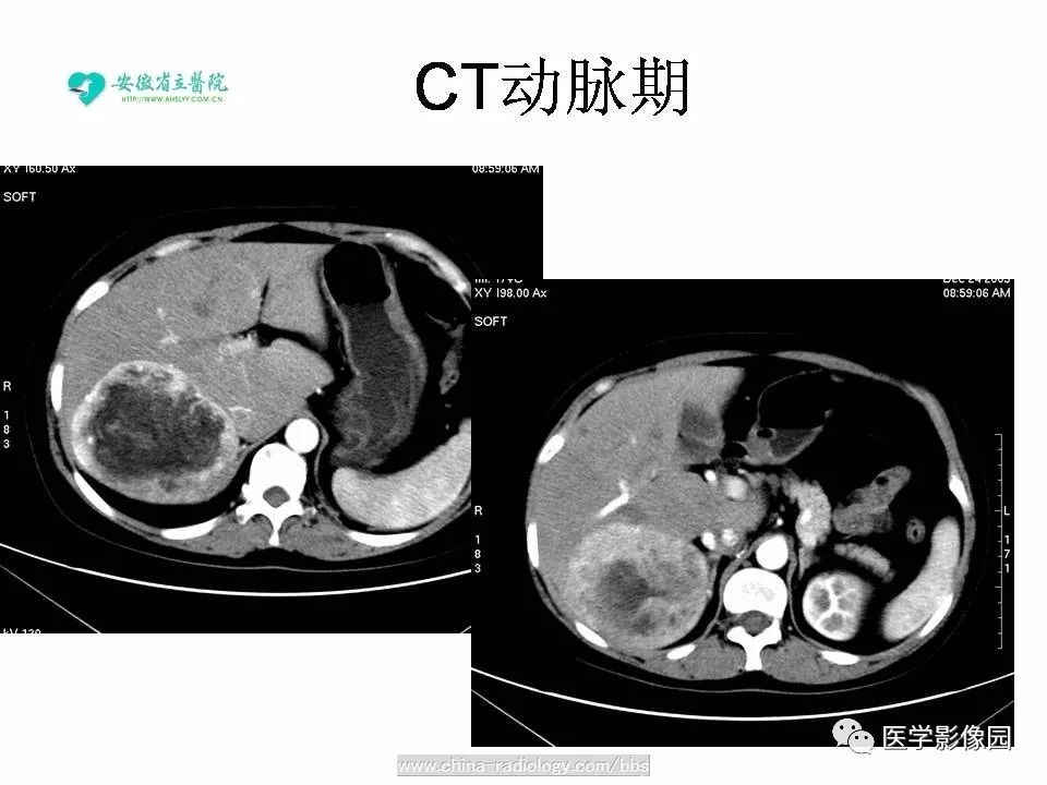 【病例】肝脏血管平滑肌脂肪瘤1例CT影像表现 【病例】肝脏血管平滑肌脂肪瘤1例CT影像表现