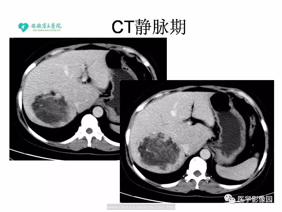 【病例】肝脏血管平滑肌脂肪瘤1例CT影像表现 【病例】肝脏血管平滑肌脂肪瘤1例CT影像表现