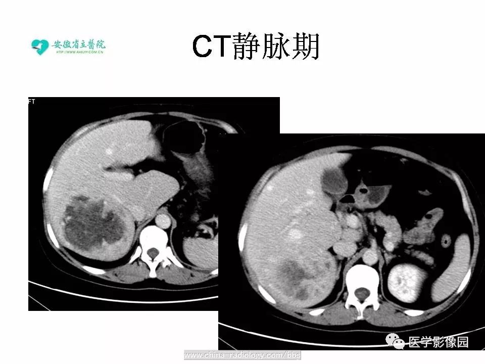【病例】肝脏血管平滑肌脂肪瘤1例CT影像表现 【病例】肝脏血管平滑肌脂肪瘤1例CT影像表现