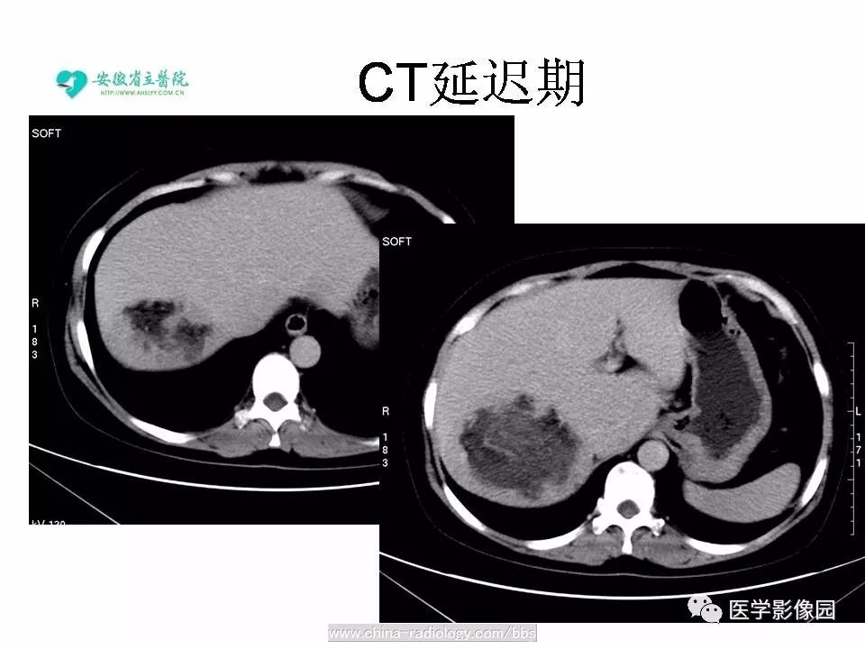 【病例】肝脏血管平滑肌脂肪瘤1例CT影像表现 【病例】肝脏血管平滑肌脂肪瘤1例CT影像表现