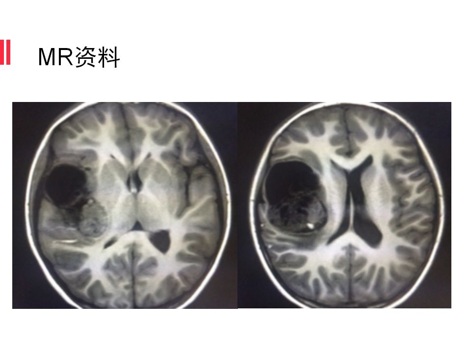 【病例】原始神经外胚层肿瘤PNET一例MR