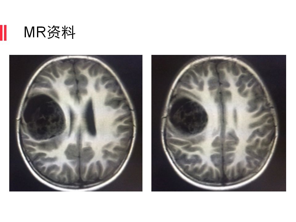 【病例】原始神经外胚层肿瘤PNET一例MR