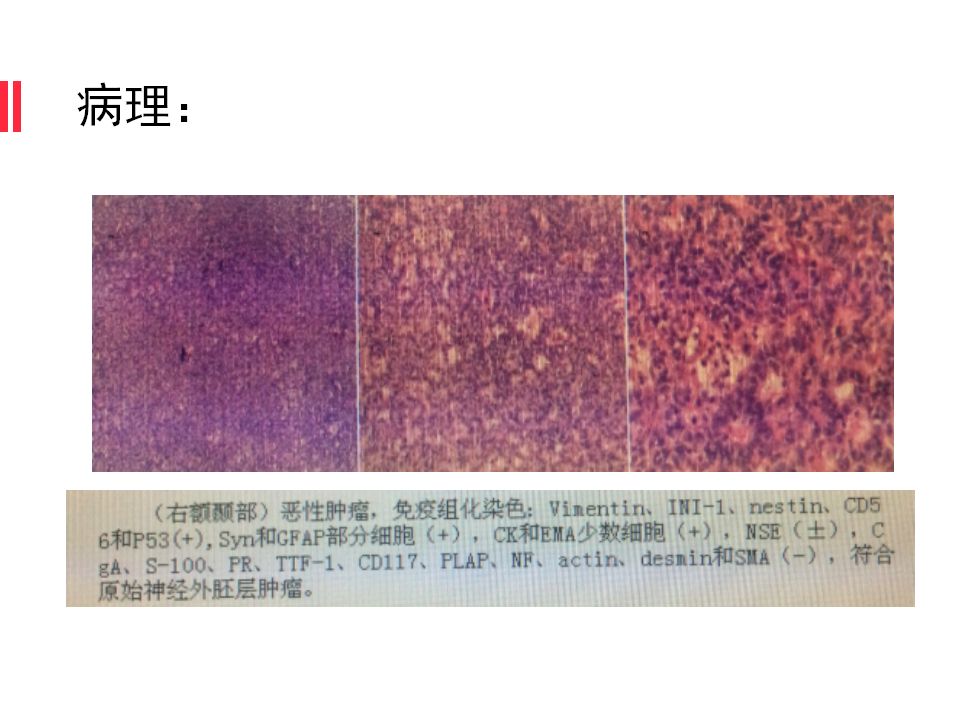 【病例】原始神经外胚层肿瘤PNET一例MR
