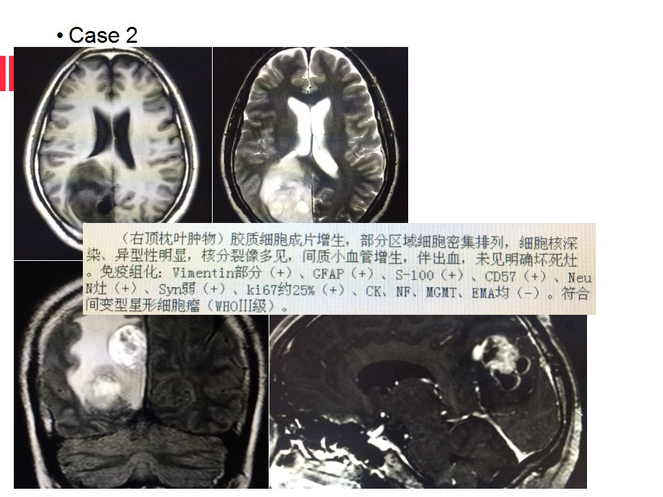 【病例】原始神经外胚层肿瘤PNET一例MR