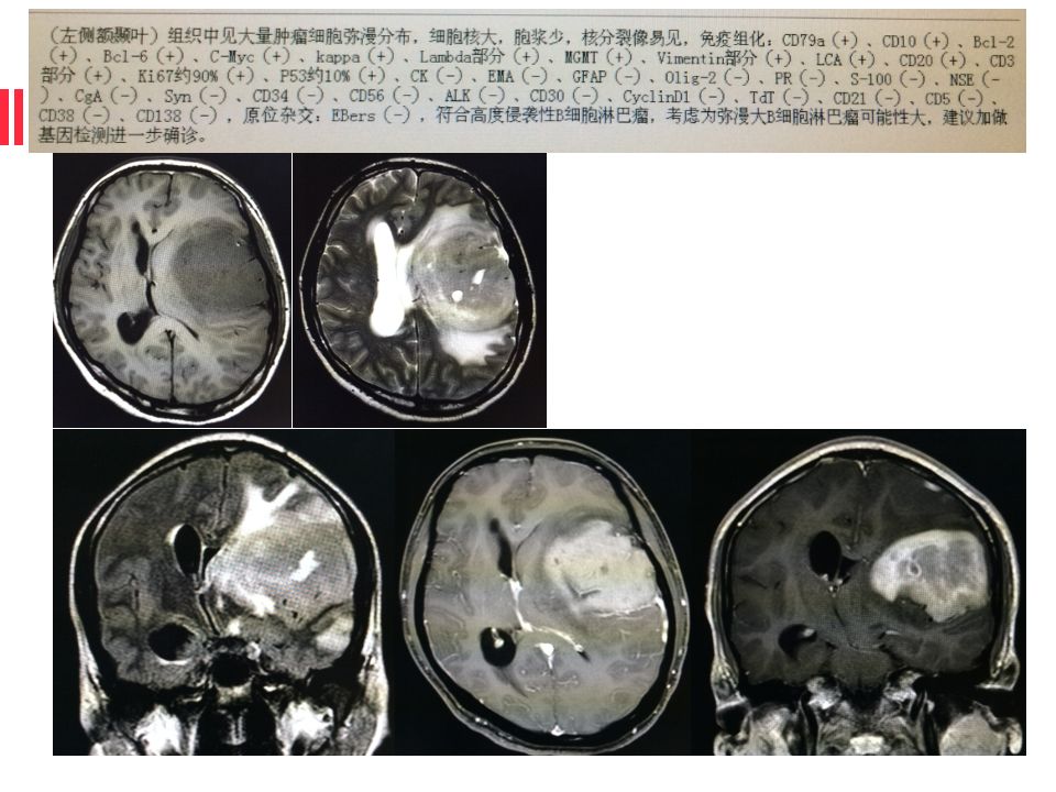 【病例】原始神经外胚层肿瘤PNET一例MR