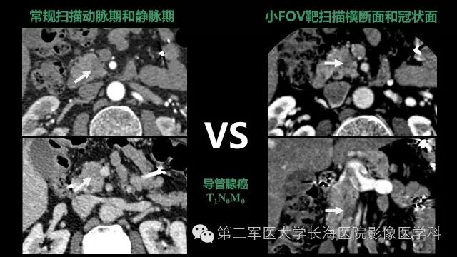 【PPT】胰腺动脉CT增强造影三维后处理与结构化报告书写