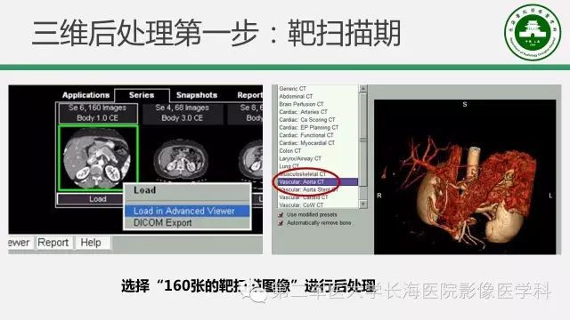【PPT】胰腺动脉CT增强造影三维后处理与结构化报告书写