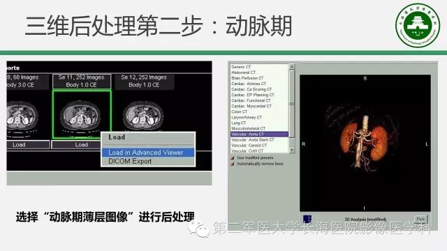 【PPT】胰腺动脉CT增强造影三维后处理与结构化报告书写